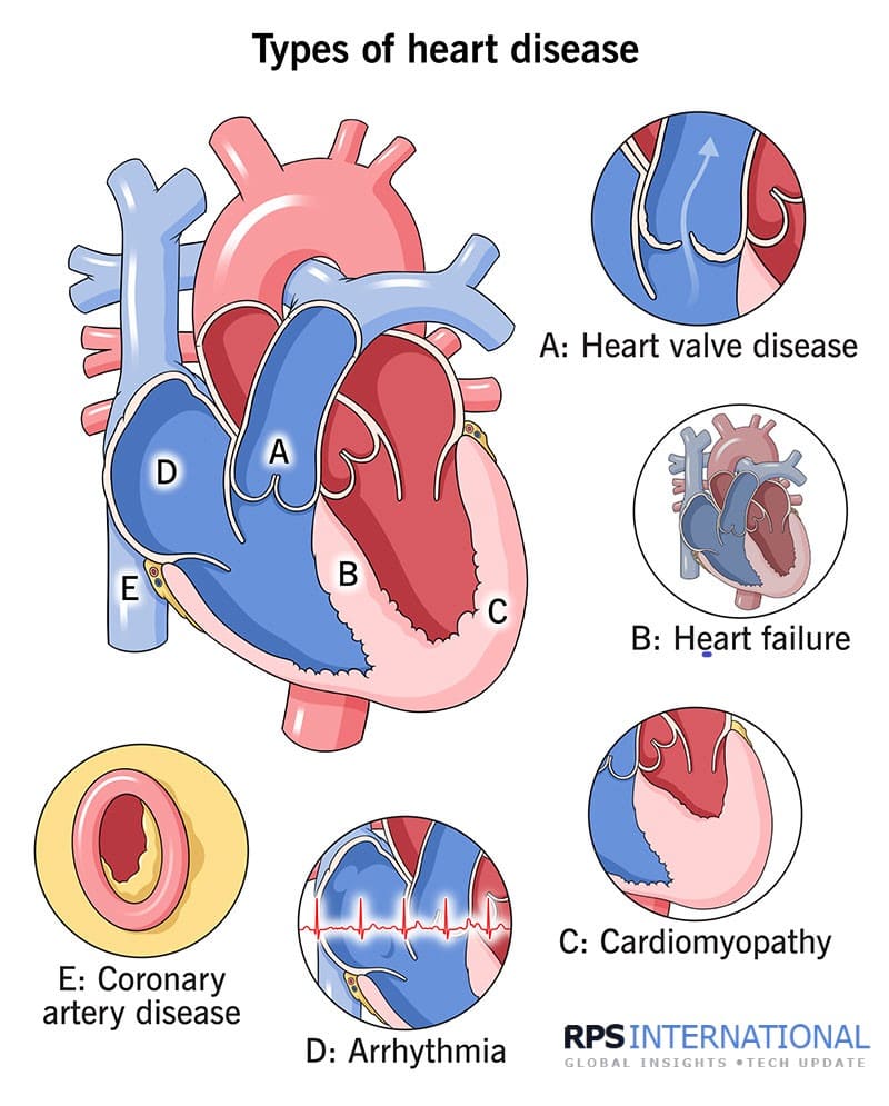 Types of Heart Disease